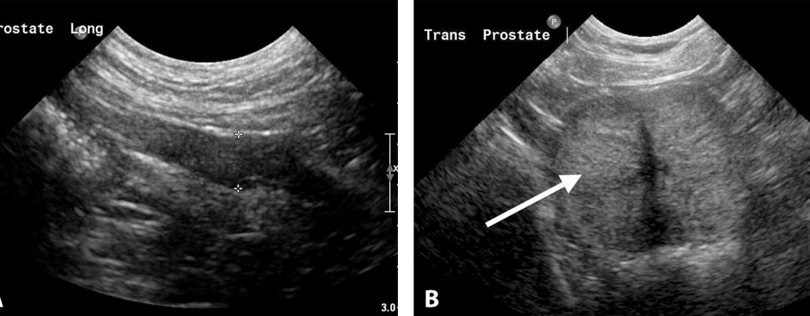 Prostat Hastaliklarinin Ultrasonografik Muayenesi