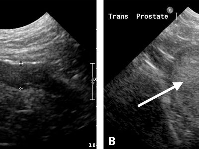 Prostat Hastaliklarinin Ultrasonografik Muayenesi