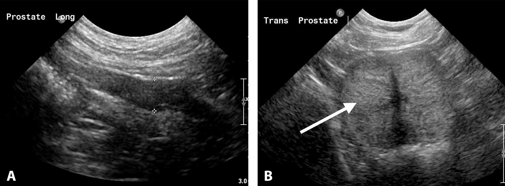 Prostat Hastaliklarinin Ultrasonografik Muayenesi